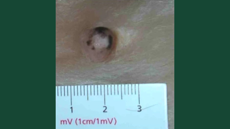 Foto av en juvertumör hos hund som mäts med linjal.