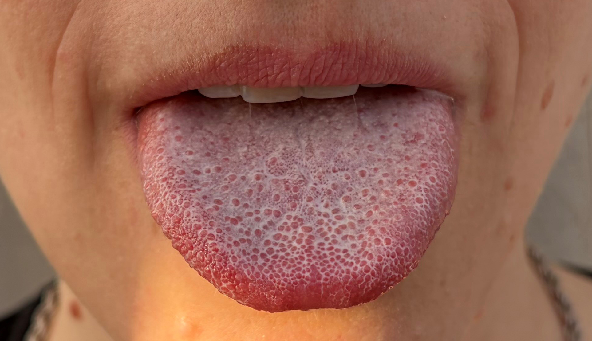 Photo of a human tongue.