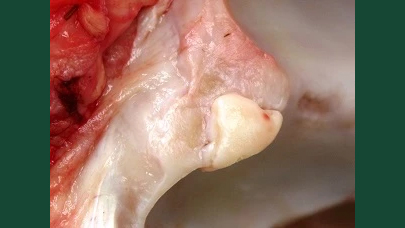 Foto av Osteokondros.