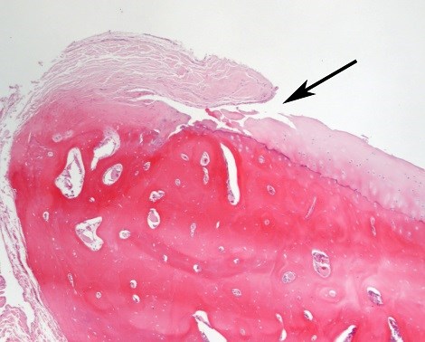 Mikroskopbild av ledförändringar